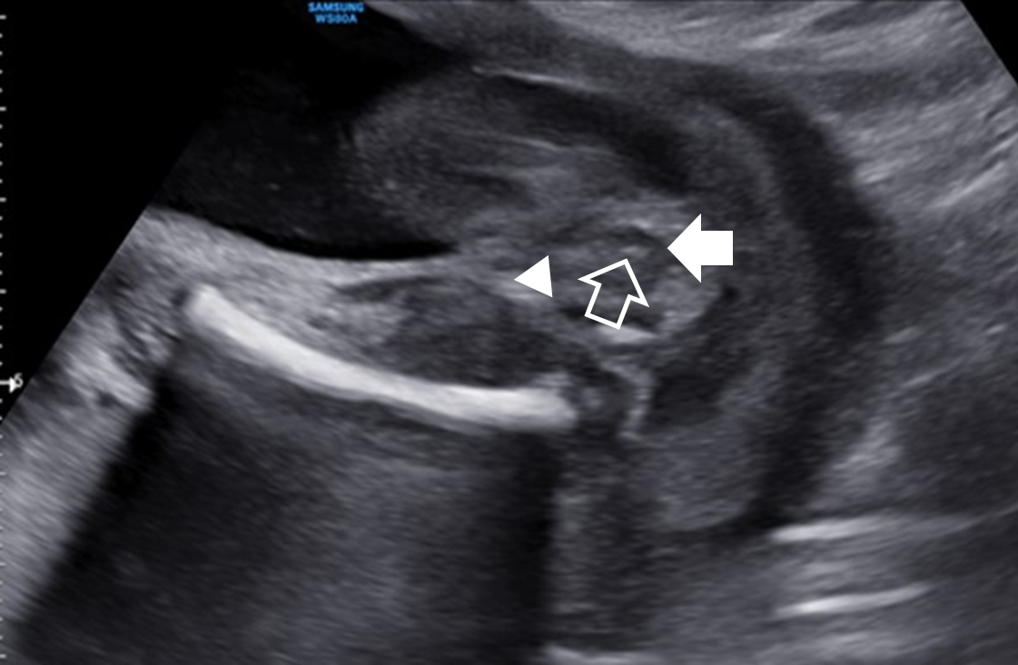 The Diagnosis Of An Imperforate Anus In Female Fetuses