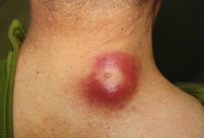 epidermoid cysts on back